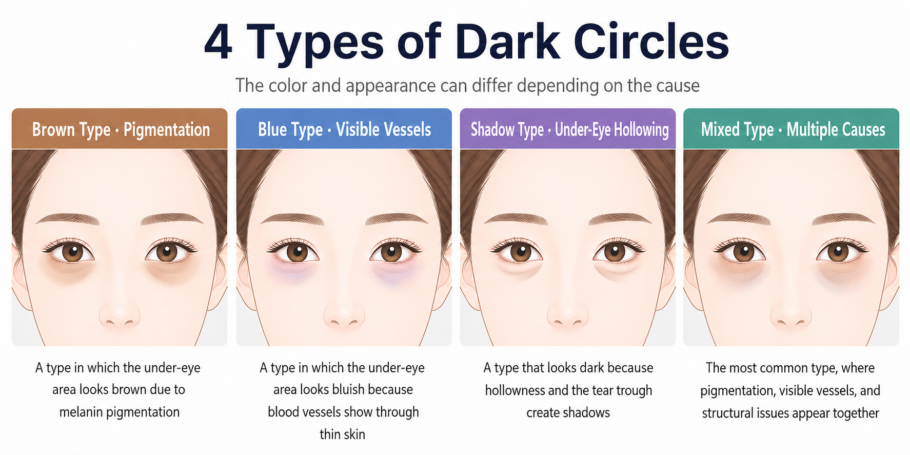 Diagram of the four types of dark circles: pigment, vascular, hollowing and skin quality