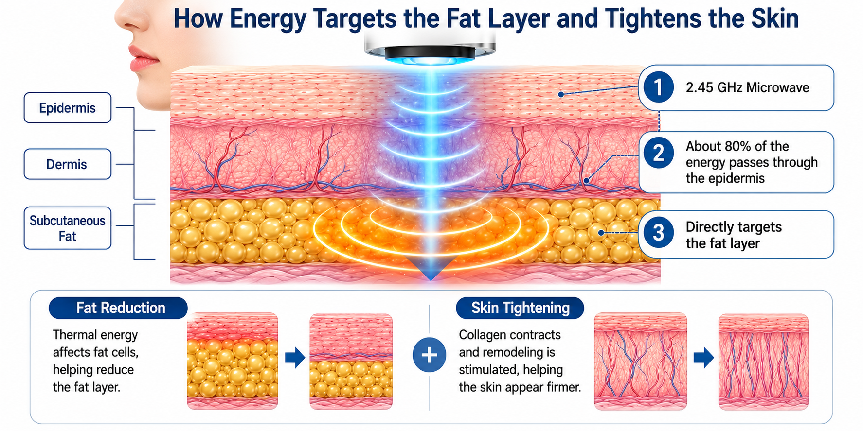 Diagram showing how non-surgical body contouring targets the fat layer and tightens skin