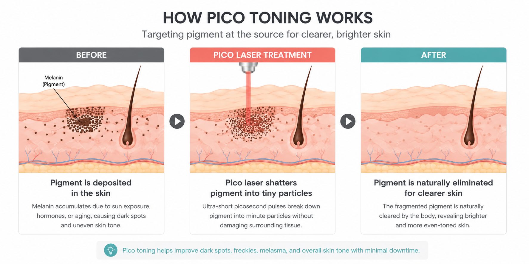 Illustration of pico laser pulses breaking pigment into particles that the body clears