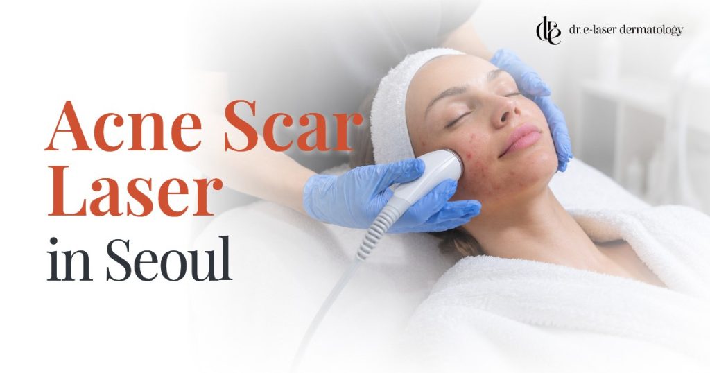 Acne scar laser treatment in Seoul doctor-led guide for English-speaking patients