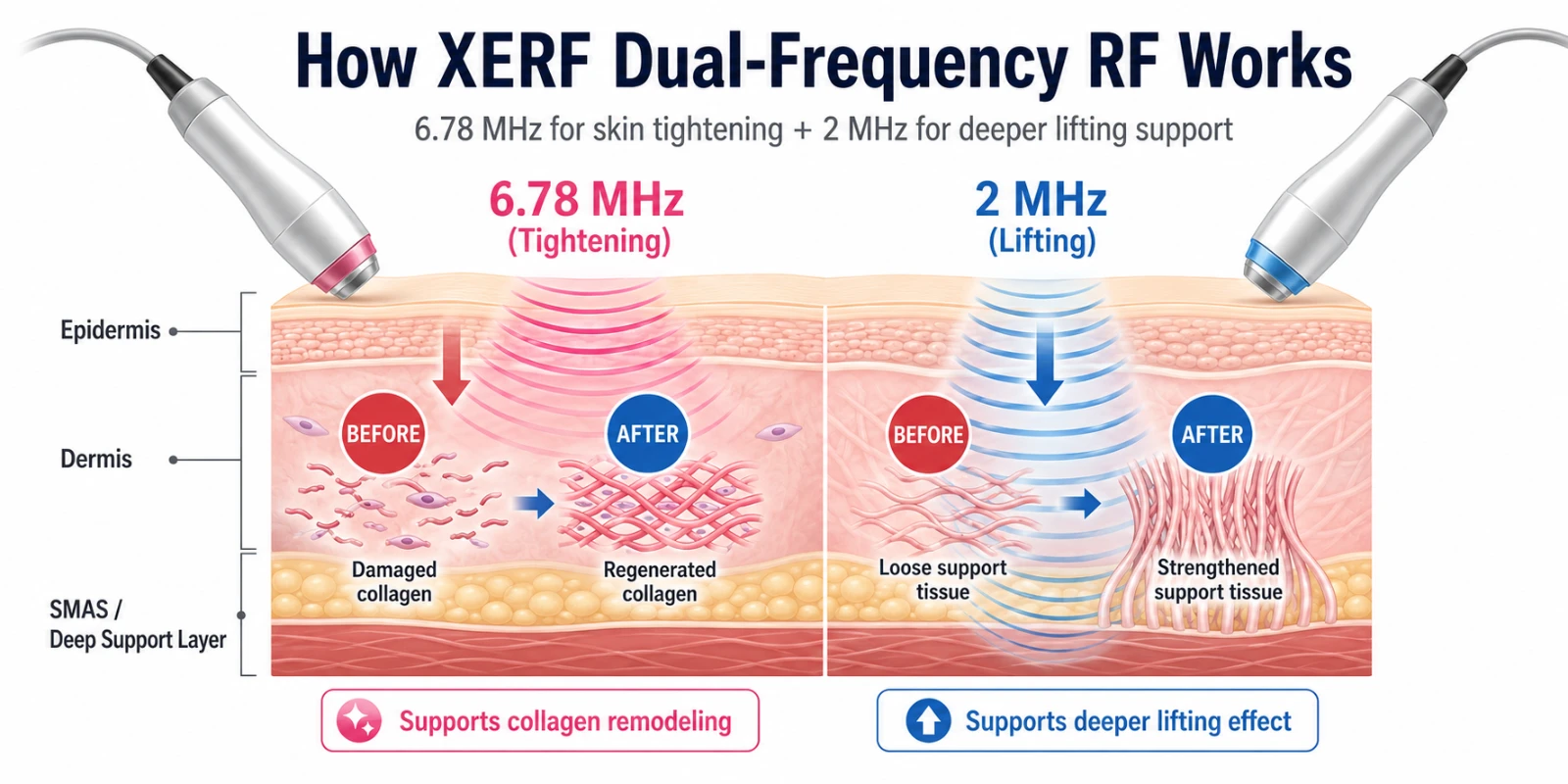 Diagram showing how XERF radiofrequency reaches the dermis and deeper structural layer