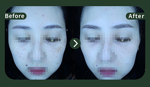 [Freckles] 30s Before and after