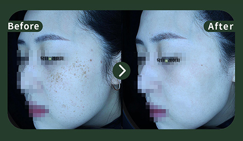 [Freckles] 30s Before and after