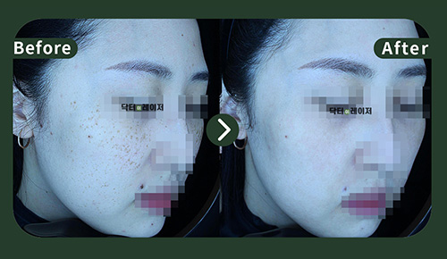 [Freckles] 30s Before and after