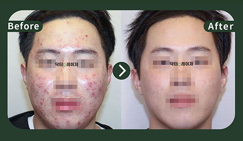 [Acne] 20s Before and after