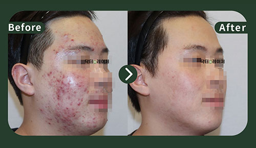 [Acne] 20s Before and after