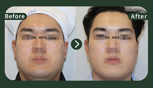 [Blemishes] 30s Before and after