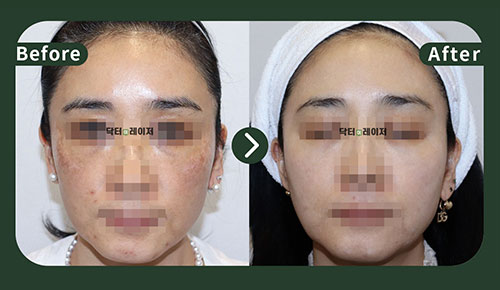 [Melasma] 40s Before and after