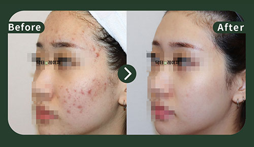 [Acne] 20s Before and after