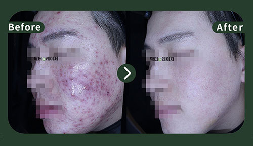 [Acne] 20s Before and after
