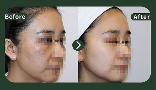 Melasma] 40s Before and after
