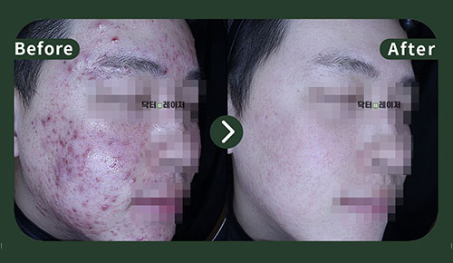 [Acne] 20s Before and after