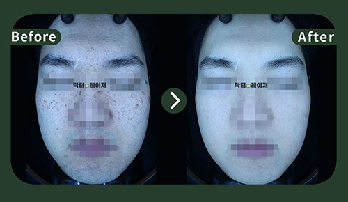 Blemishes] 30s Before and after