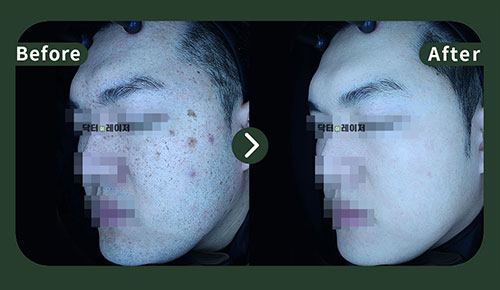 Blemishes] 30s Before and after