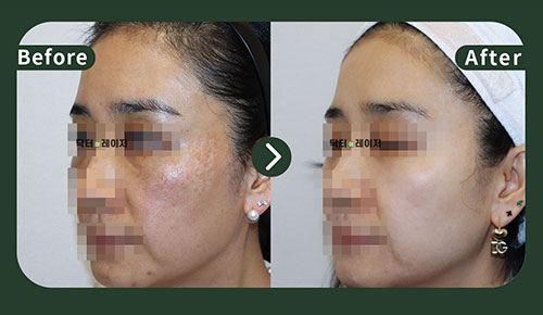[Melasma] 40s Before and after