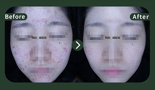 [Acne] 20s Before and after