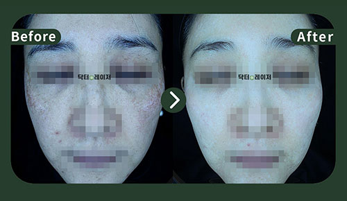 [Melasma] 40s Before and after