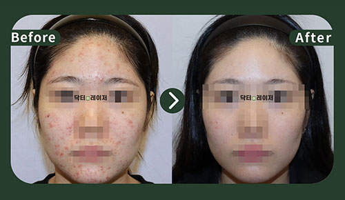 [Acne] 20s Before and after