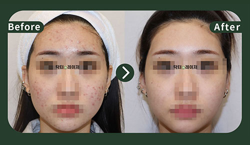 [Acne] 20s Before and after