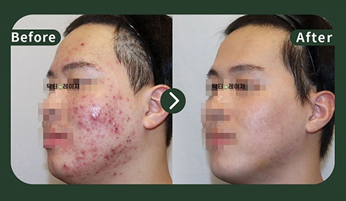 [Acne] 20s Before and after
