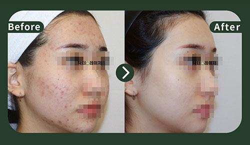 [Acne] 20s Before and after