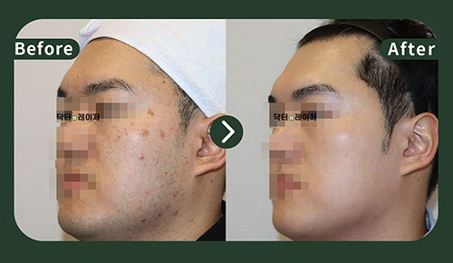 [Blemishes] 30s Before and after