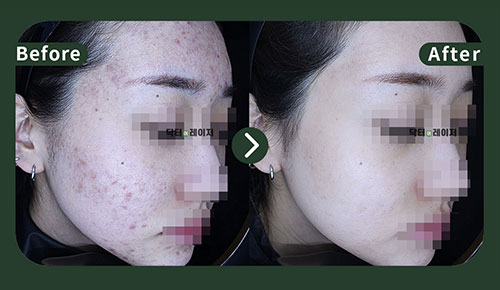 [Acne] 20s Before and after
