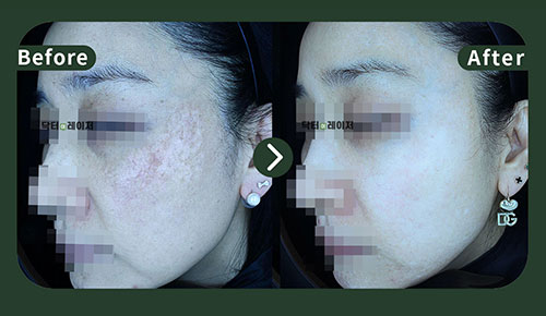 [Melasma] 40s Before and after