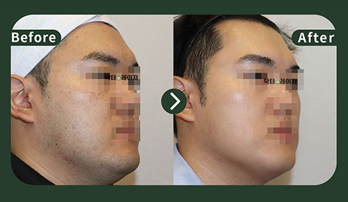 [Blemishes] 30s Before and after