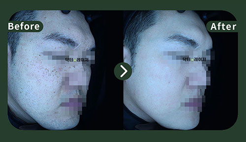 [Blemishes] 30s Before and after