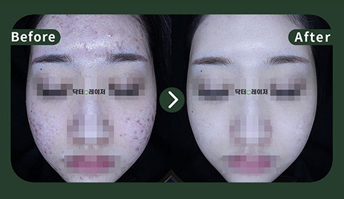 [Acne] 20s Before and after