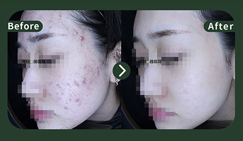 [Acne] 20s Before and after