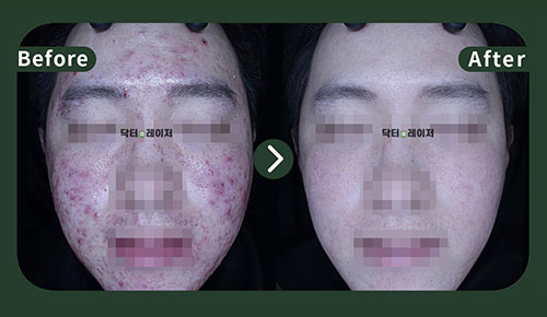 [Acne] 20s Before and after
