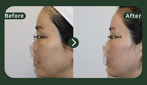 [Melasma/Lifting] 50s Before and after