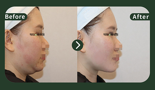 [Lifting] 20s Before and after