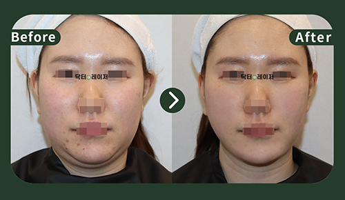 [Lifting] 20s Before and after
