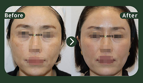 [Melasma/Lifting] 50s Before and after