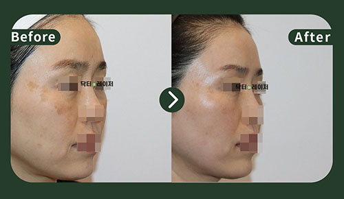 [Melasma/Lifting] 50s Before and after