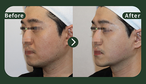 [Lifting] 30s Before and after