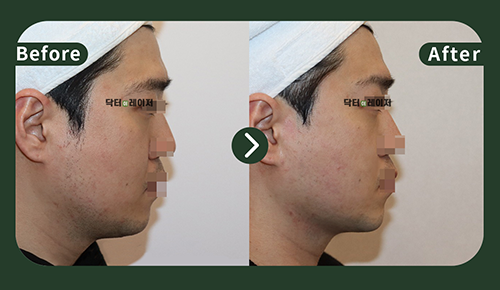 [Lifting] 30s Before and after