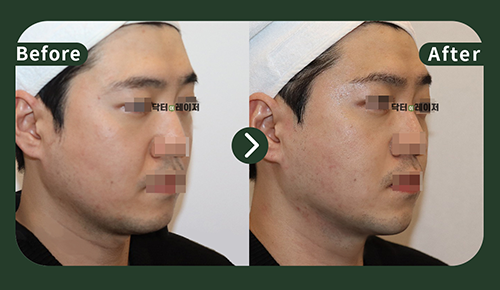 [Lifting] 30s Before and after