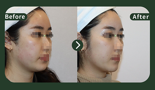 [Lifting] 30s Before and after