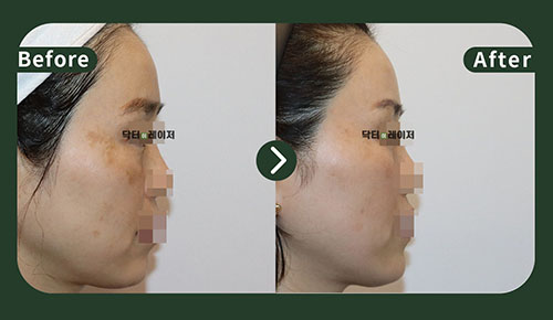 [Melasma/Lifting] 50s Before and after