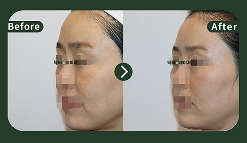 [Melasma/Lifting] 50s Before and after