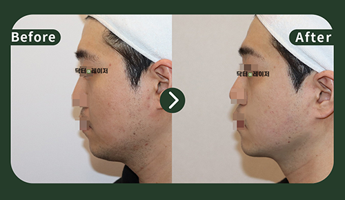 [Lifting] 30s Before and after