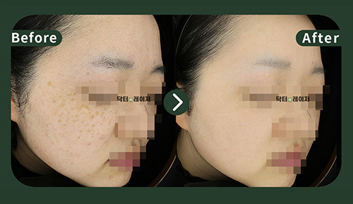 [Melasma] 20s Before and after
