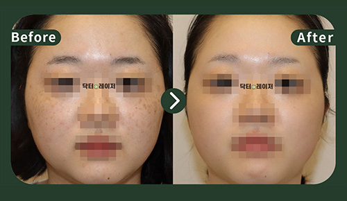 [Melasma] 20s Before and after