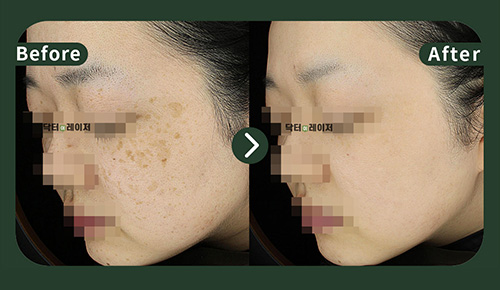 [Melasma] 20s Before and after