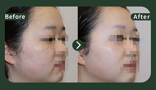 [Melasma] 20s Before and after