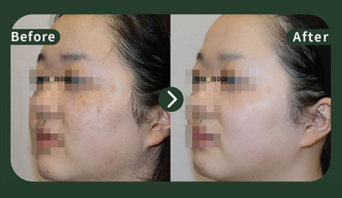 [Melasma] 20s Before and after